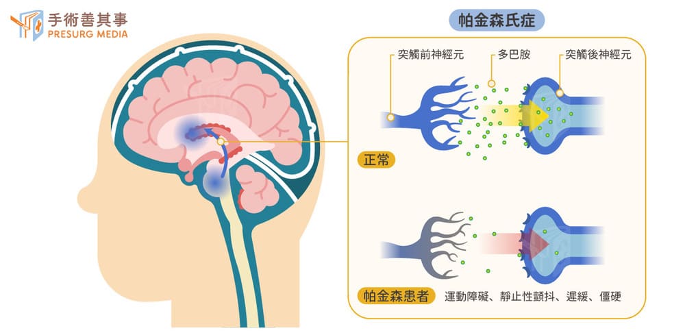 帕金森氏症治療：該吃藥還是要開刀？超音波聚焦燒融不開腦也能治！