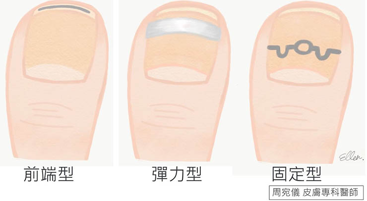 凍甲的三種矯正器圖示