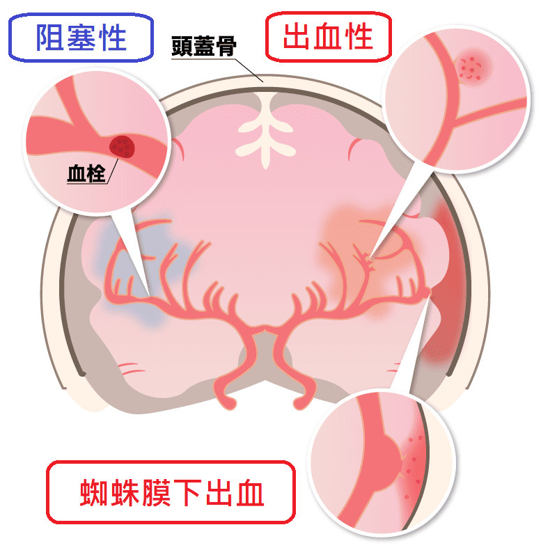 納豆腦出血開刀，小心!中風不是只有老人才會得，認識腦中風常見症狀｜家天使-找看護第一品牌