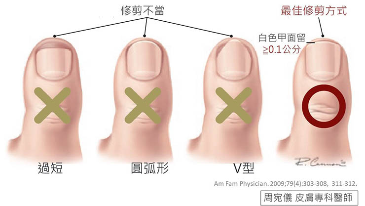 修剪指甲
