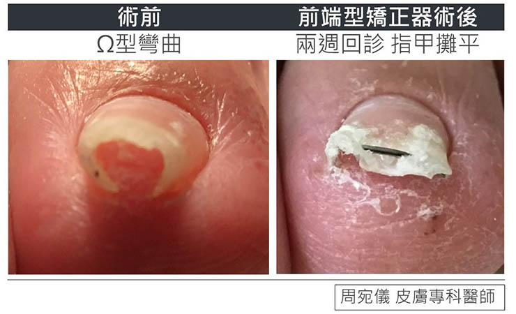 凍甲-前端型矯正器