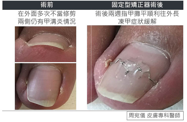 凍甲-固定型矯正器