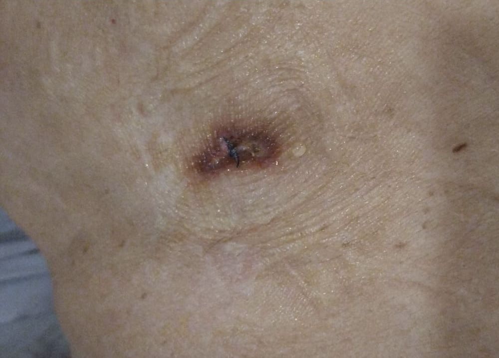 增生期傷口照片