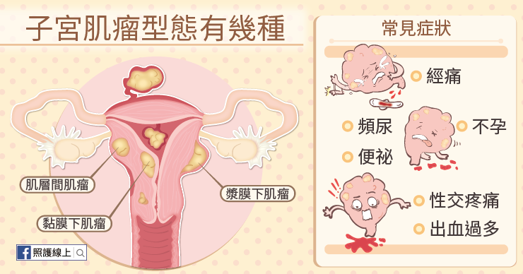 子宮肌瘤2