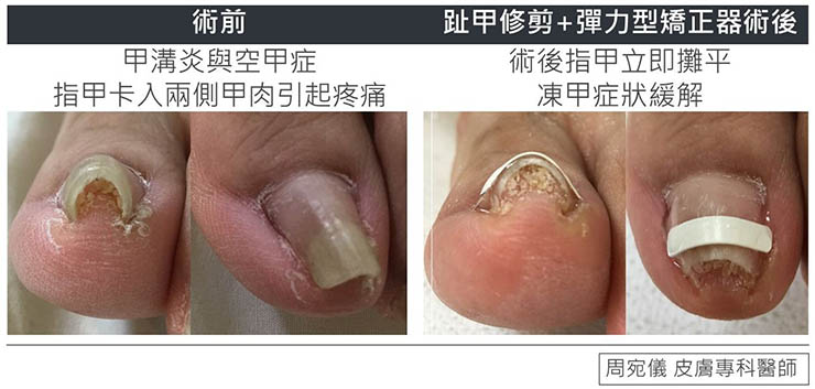 凍甲-彈力型矯正器