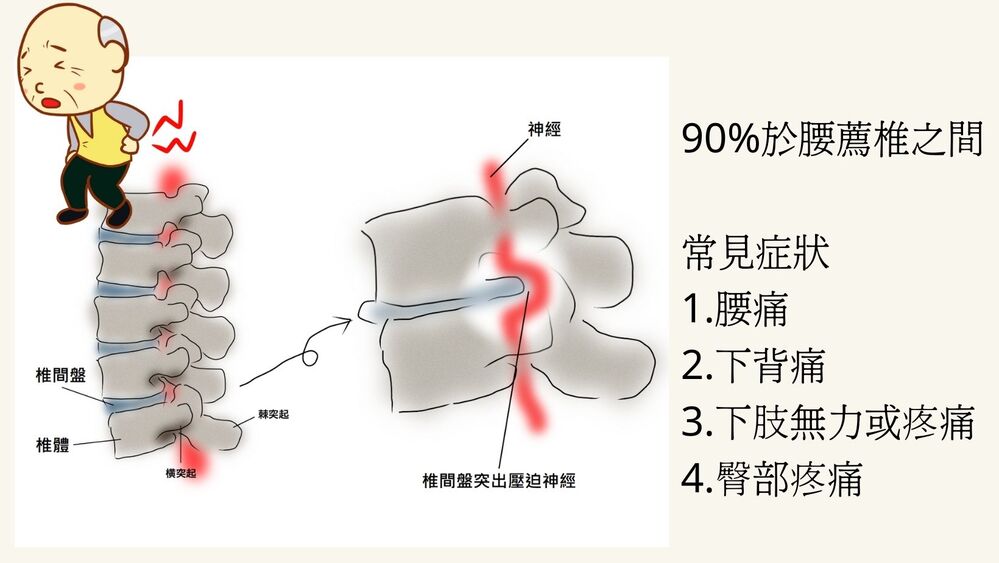 椎間盤突出症狀與好發位置