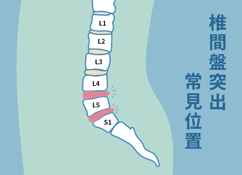 椎間盤突出_常見位置