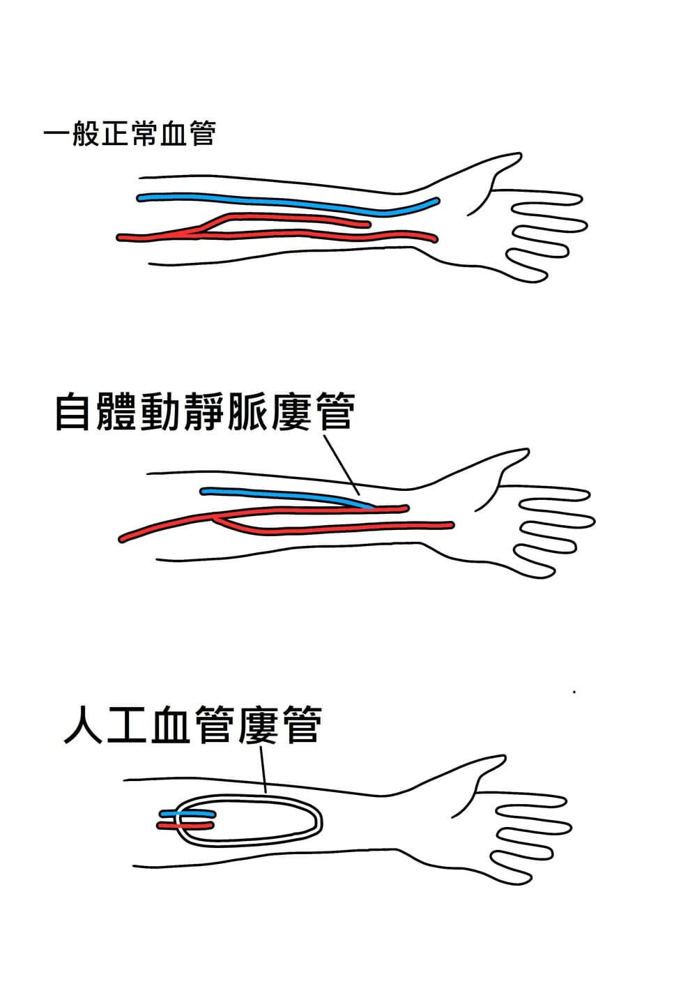 自體動靜脈廔管與人工血管廔管示意圖