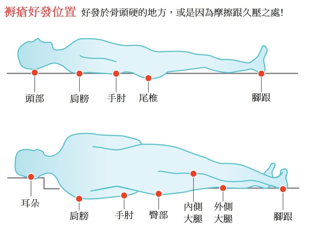 褥瘡好發位置
