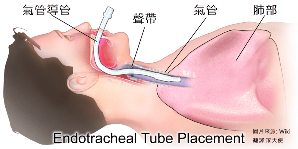 插管示意圖