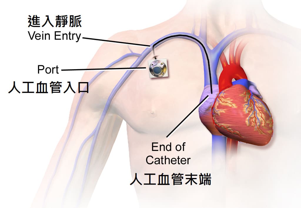 人工血管適合對象