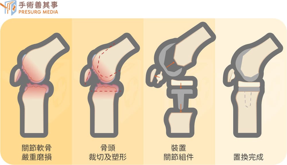 人工膝關節置換手術流程