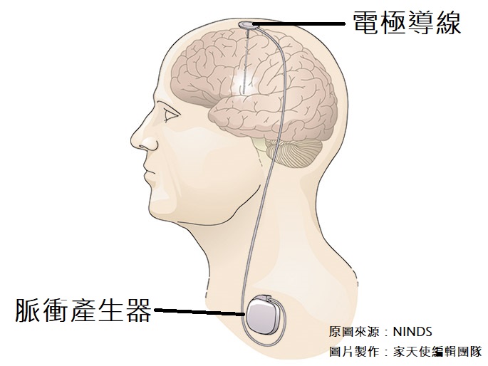 深腦部刺激術DBS